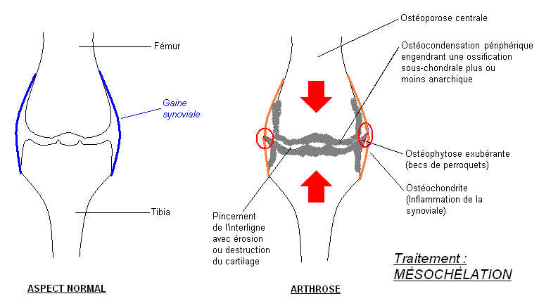 Schémas de l'arthrose du genou
