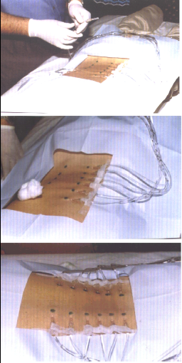 Exemple pratique : Canal lombaire étroit avec discopathie L5 - S1 et stéophytose exubérante